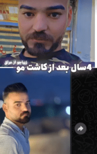 نمونه کاشت ابرو کلینیک پدیده