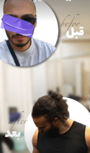 نمونه کاشت ابرو کلینیک پدیده