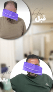 نمونه کاشت ابرو کلینیک پدیده