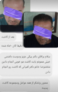 نظر کاربر اینستاگرام (کلینیک کاشت مو و ابرو پدیده)