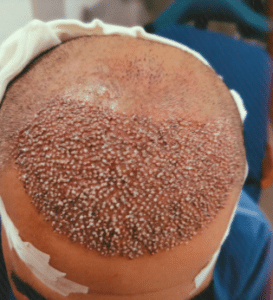 نمونه کاشت مو کلینیک پدیده