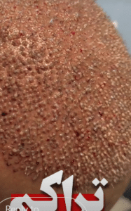 نمونه کاشت مو کلینیک پدیده