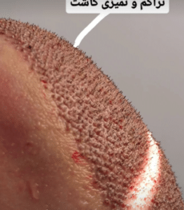 نمونه کاشت مو کلینیک پدیده