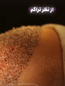 نمونه کاشت مو کلینیک پدیده