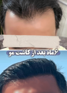 نمونه کاشت مو کلینیک پدیده