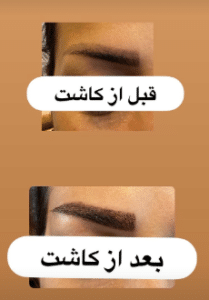 نمونه کاشت ابرو کلینیک پدیده