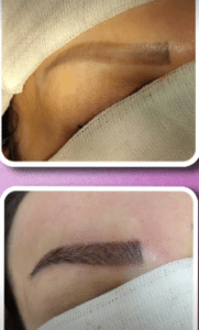 نمونه کاشت ابرو کلینیک پدیده