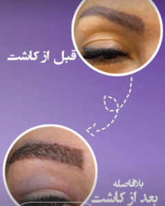 نمونه کاشت ابرو کلینیک پدیده