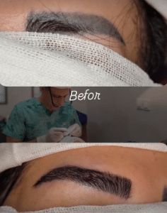 نمونه کاشت ابرو کلینیک پدیده