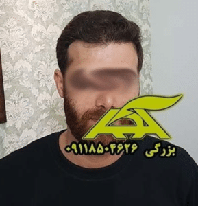 نمونه کاشت مو (کلینیک کاشت موی آرا)