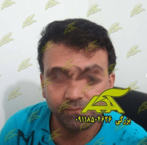 نمونه کاشت مو (کلینیک کاشت موی آرا)