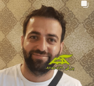 نمونه کاشت مو (کلینیک کاشت موی آرا)