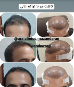 نمونه کاشت مو (کلینیک کاشت موی آرا)