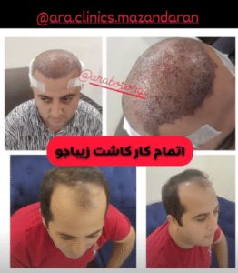 نمونه کاشت مو (کلینیک کاشت موی آرا)