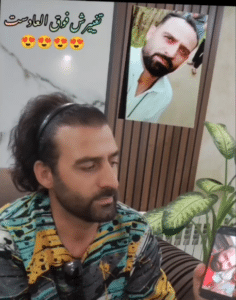 نمونه کاشت مو (کلینیک کاشت موی آرا)