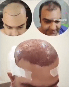 نمونه کاشت مو (کلینیک کاشت موی آرا)