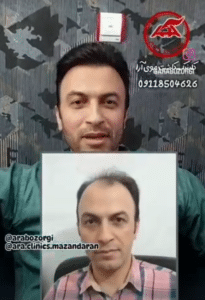 نمونه کاشت مو (کلینیک کاشت موی آرا)