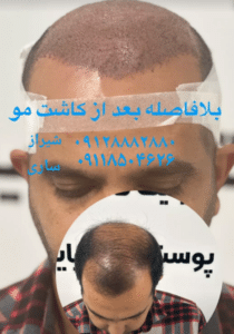 نمونه کاشت مو (کلینیک کاشت موی آرا)