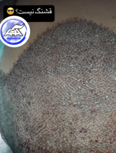 نمونه کاشت مو (کلینیک کاشت موی آرا)