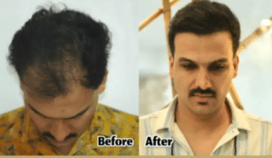 نمونه کاشت مو (کلینیک کاشت موی آرا)