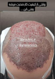 نمونه کاشت مو (کلینیک کاشت موی آرا)