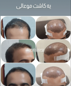 نمونه کاشت مو (کلینیک کاشت موی آرا)