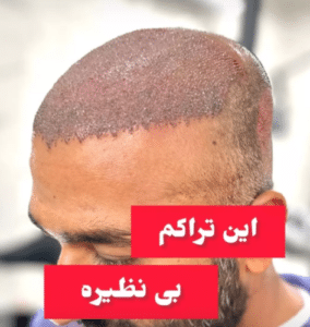 نمونه کاشت مو (کلینیک کاشت موی آرا)