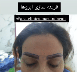 نمونه کاشت ابرو (کلینیک کاشت موی آرا)
