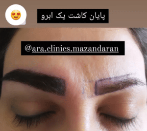 نمونه کاشت ابرو (کلینیک کاشت موی آرا)