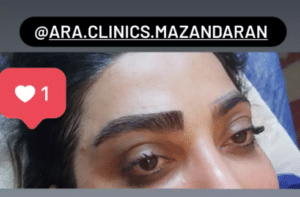 نمونه کاشت ابرو (کلینیک کاشت موی آرا)