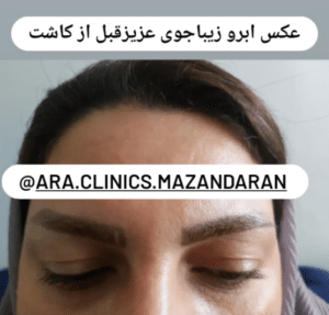 نمونه کاشت ابرو (کلینیک کاشت موی آرا)