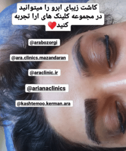 نمونه کاشت ابرو (کلینیک کاشت موی آرا)