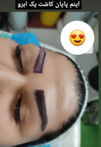 نمونه کاشت ابرو (کلینیک کاشت موی آرا)