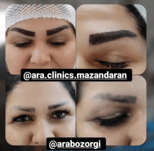 نمونه کاشت ابرو (کلینیک کاشت موی آرا)
