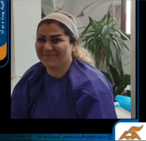 نمونه کاشت ابرو (کلینیک کاشت موی آرا)
