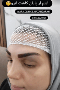 نمونه کاشت ابرو (کلینیک کاشت موی آرا)