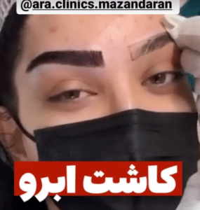 نمونه کاشت ابرو (کلینیک کاشت موی آرا)