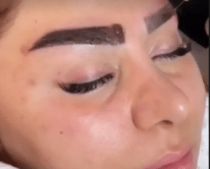 نمونه کاشت ابرو (کلینیک کاشت موی آرا)