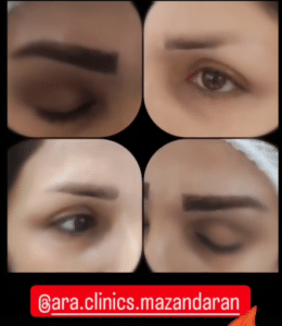 نمونه کاشت ابرو (کلینیک کاشت موی آرا)