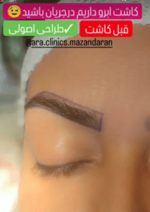 نمونه کاشت ابرو (کلینیک کاشت موی آرا)
