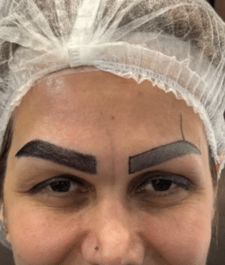 نمونه کاشت ابرو (کلینیک کاشت موی آرا)