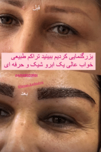 نمونه کاشت ابرو (کلینیک کاشت موی آرا)