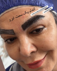 نمونه کاشت ابرو (کلینیک کاشت موی آرا)