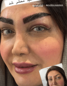 نمونه کاشت ابرو (کلینیک کاشت موی آرا)