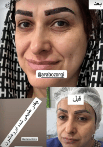نمونه کاشت ابرو (کلینیک کاشت موی آرا)