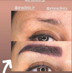 نمونه کاشت ابرو (کلینیک کاشت موی آرا)