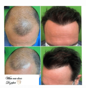 نمونه کاشت مو دکتر محمود جعفری (کلینیک رز سفید)