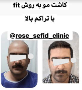 نمونه کاشت مو دکتر محمود جعفری (کلینیک رز سفید)
