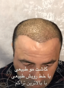 نمونه کاشت مو دکتر محمود جعفری (کلینیک رز سفید)