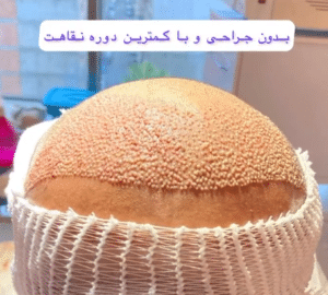 نمونه کاشت مو دکتر محمود جعفری (کلینیک رز سفید)